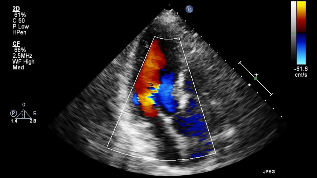 Ultrasound echocardiogram image showing heart structure and function