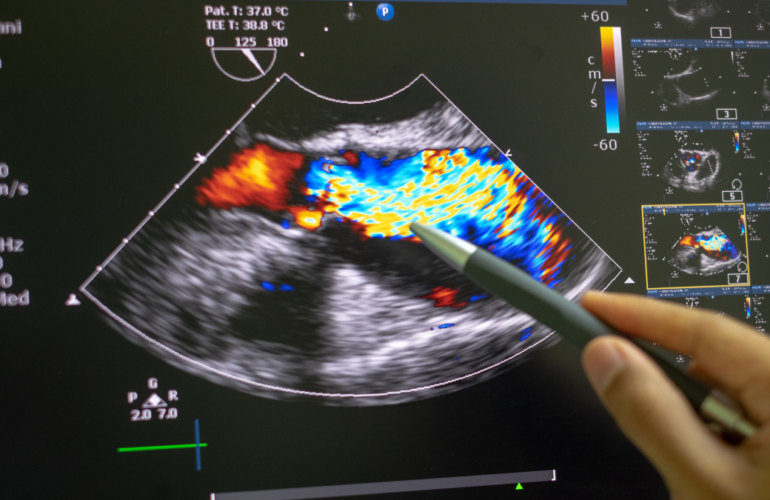 Echocardiography Essentials for Monitoring Heart Health