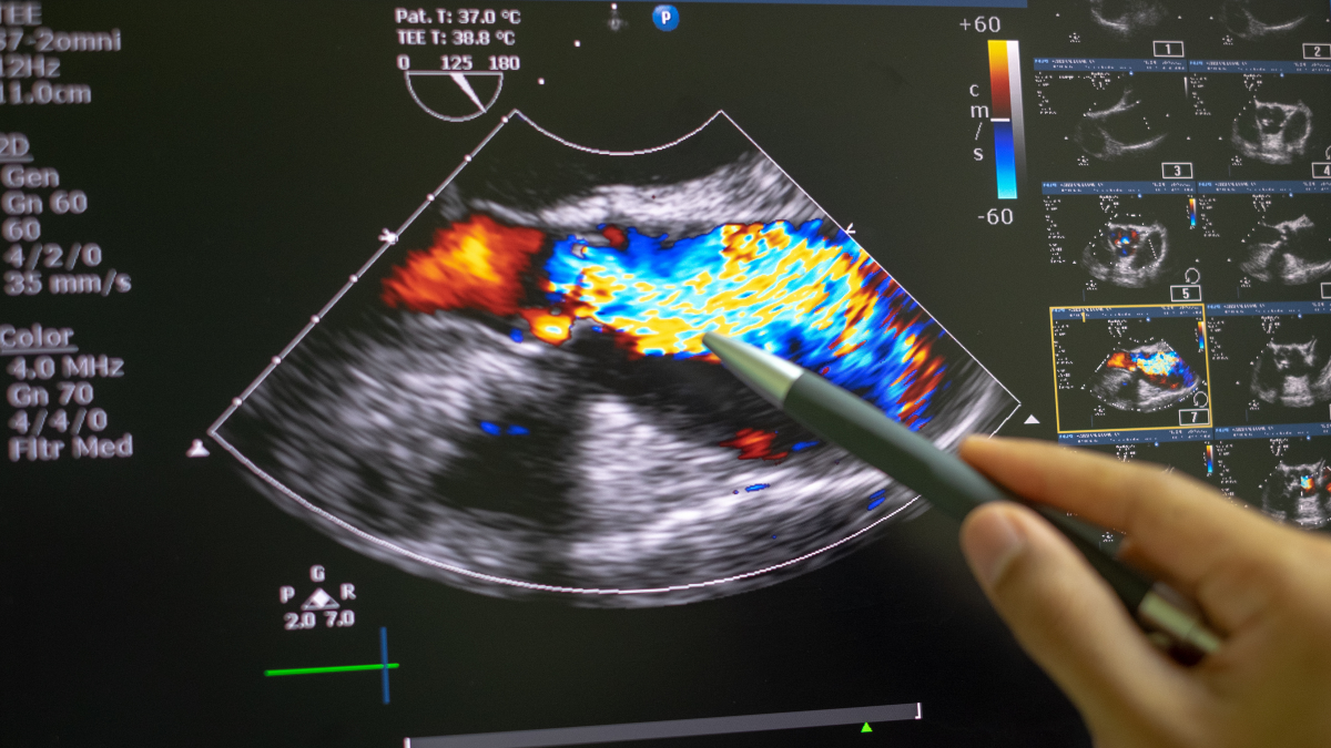 Echocardiography Essentials for Monitoring Heart Health