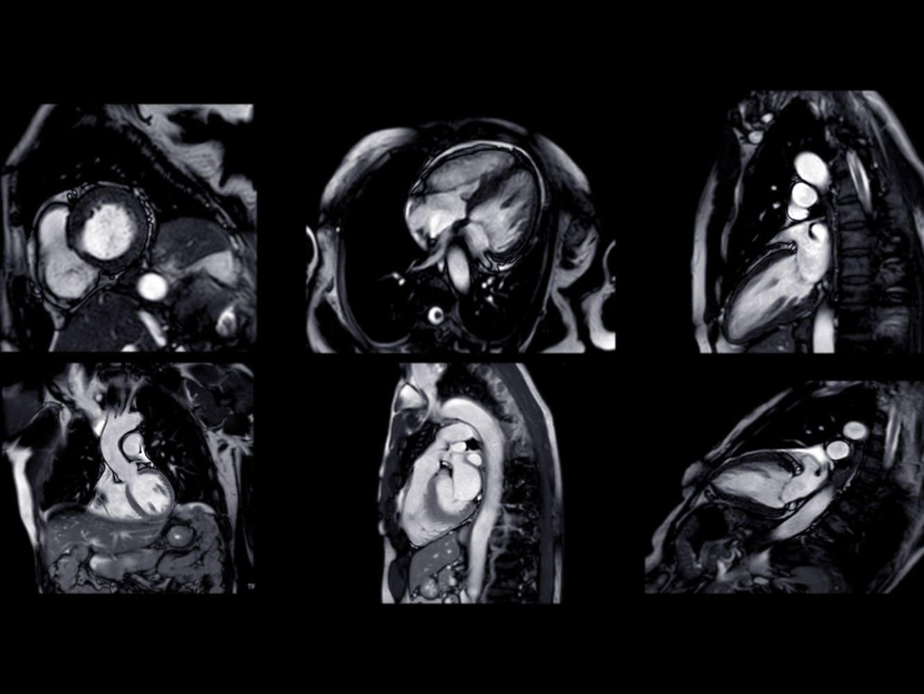 High-resolution Cardiac MRI image showing the heart’s blood vessels, muscles, and valves for early detection of heart disease.