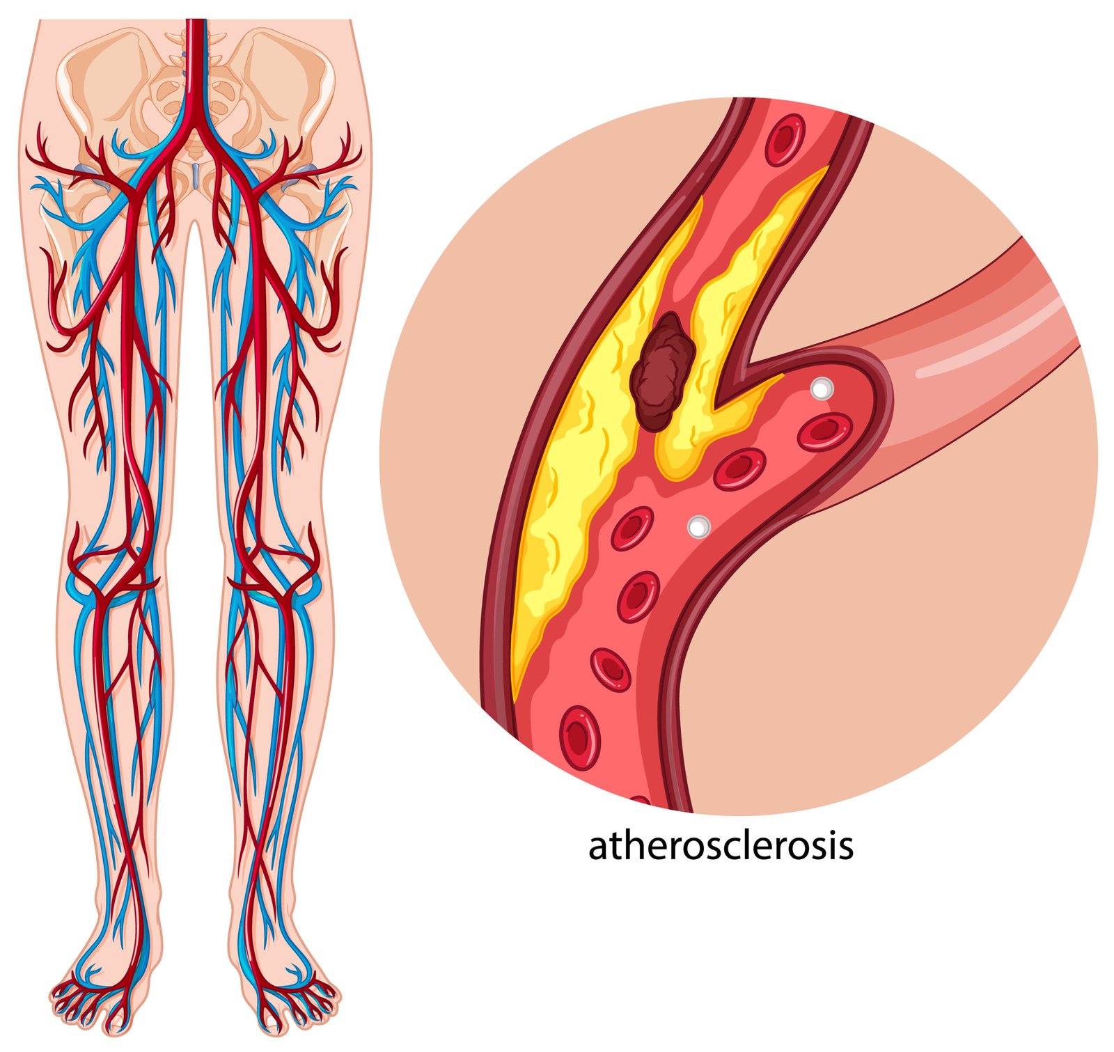 Diagram showing narrowed arteries due to Peripheral Arterial Disease (PAD).