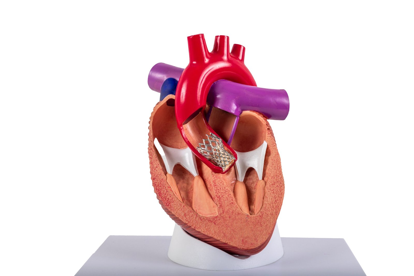 Cardiac,Model,Of,Transcatheter,Aortic,Valve,Implantation,(tavi),For,People