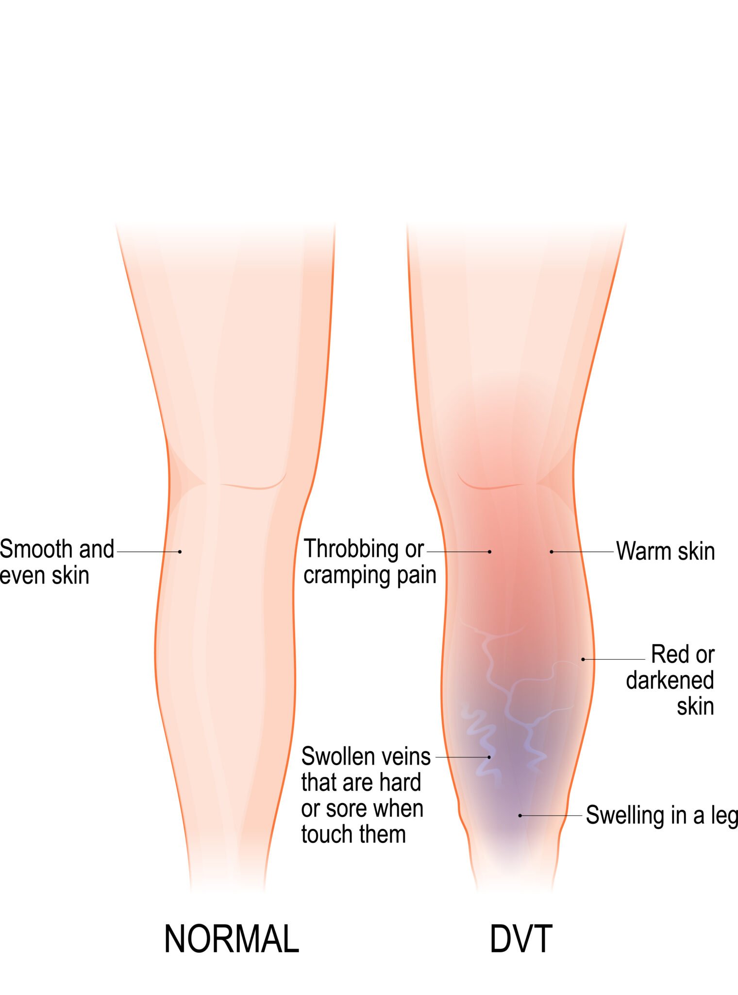 Stop The Clot Understanding Deep Vein Thrombosis stop-the-clot-understanding-deep-vein-thrombosis