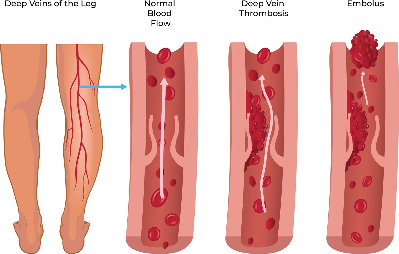 Deep Vein Thrombosis Emerging Tech Using Sonar To Treat Deep Vein