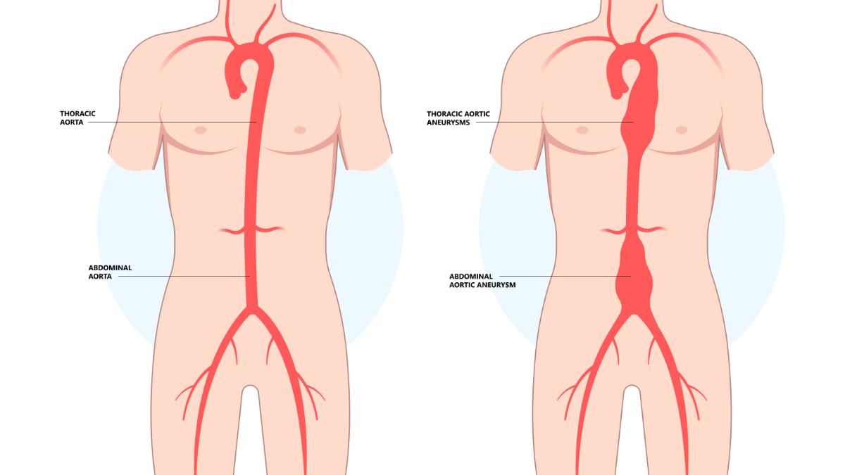 Abdominal Aortic Aneurysm (AAA)