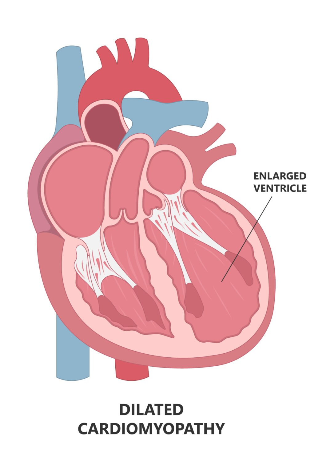 Cardiomyopathy Causes, Symptoms & Treatments