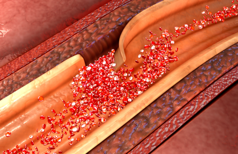 Torn from Within Understanding Aortic Dissections and How We Save Lives