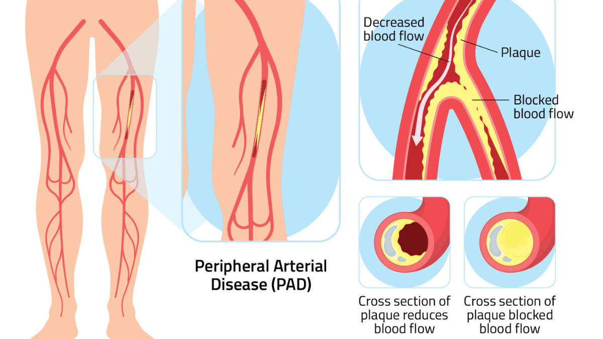 Diabetic Limb Salvage Centre Penang – Save Your Limbs Early