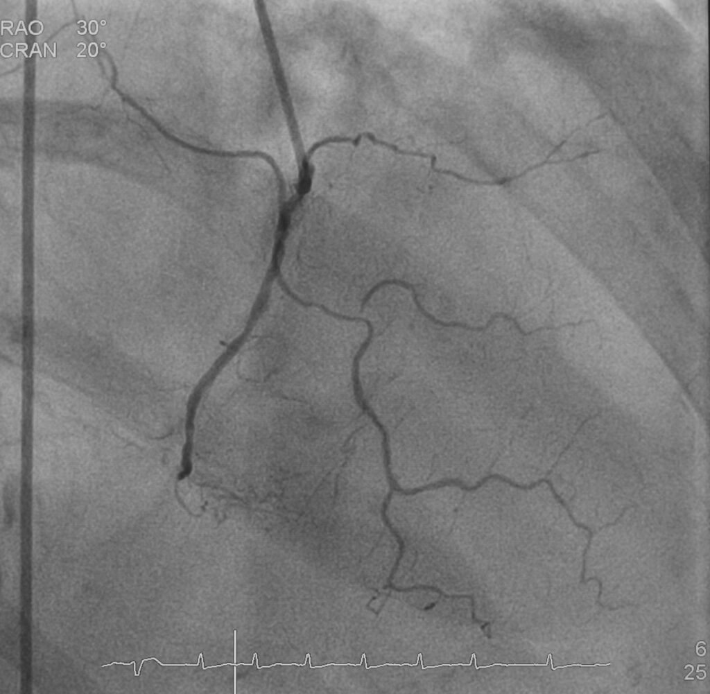 Chronic total occlusion (CTO) at right coronary artery.