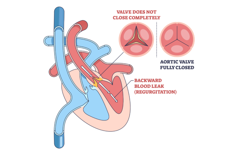 heart valve regurgitation