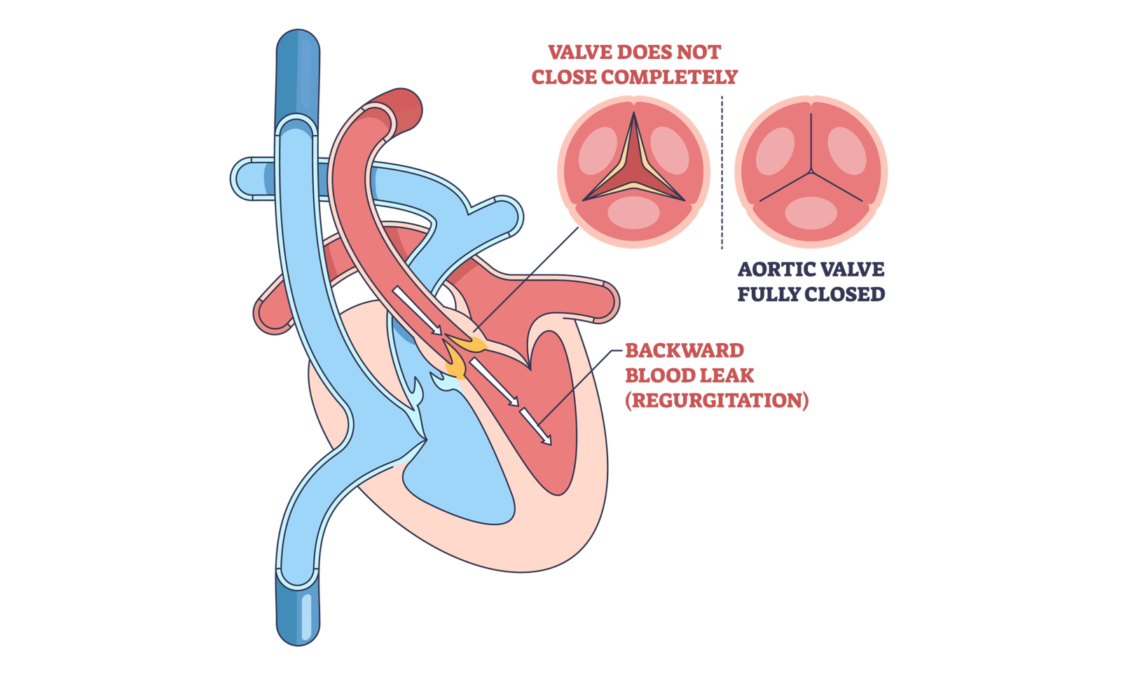 heart valve regurgitation